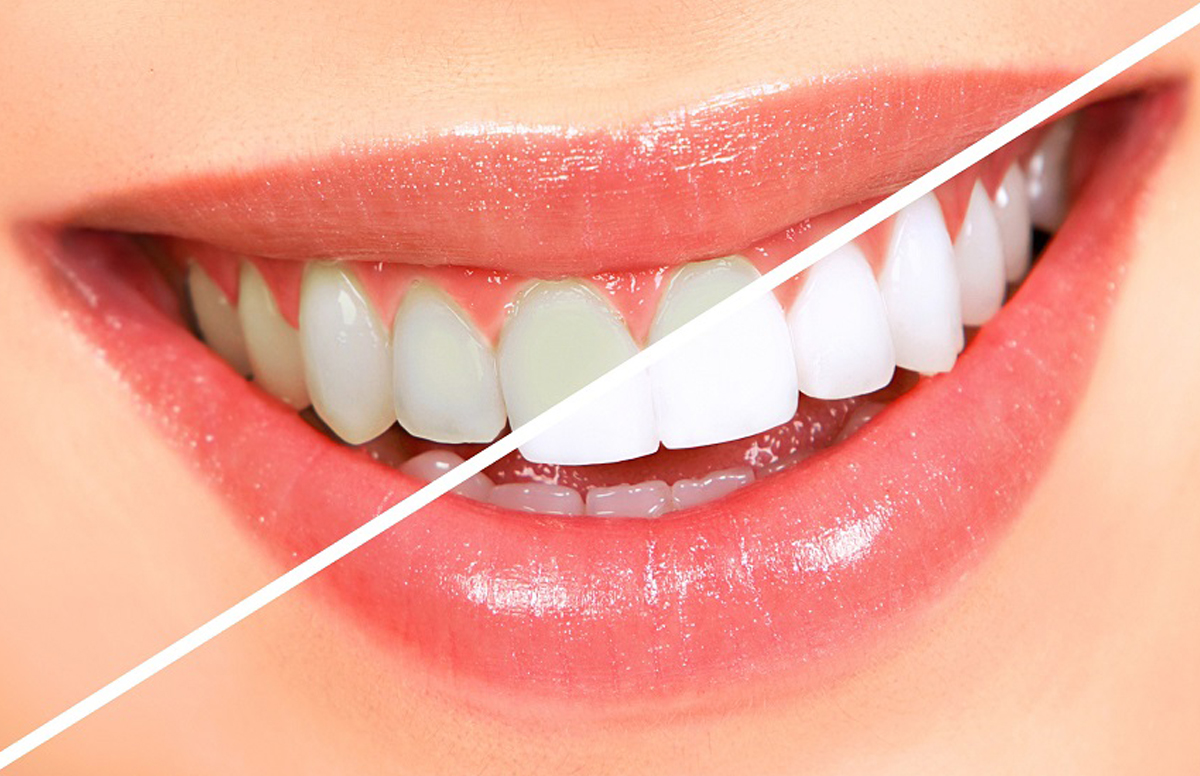 Blanqueamiento Dental: Desmintiendo Mitos y Consejos Clave